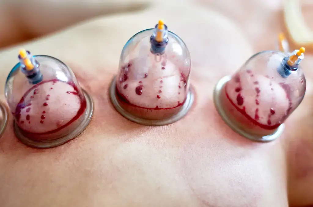 wet cupping therapy in Mumbai