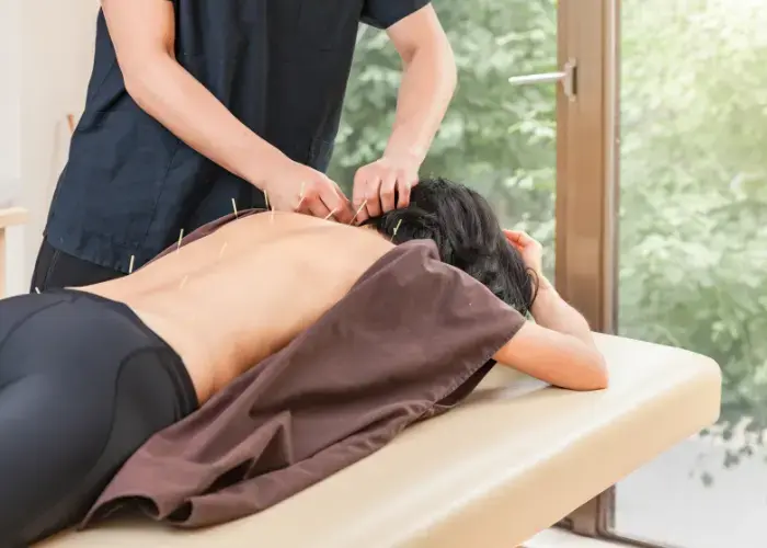 Dry Needling Therapy for back pain
