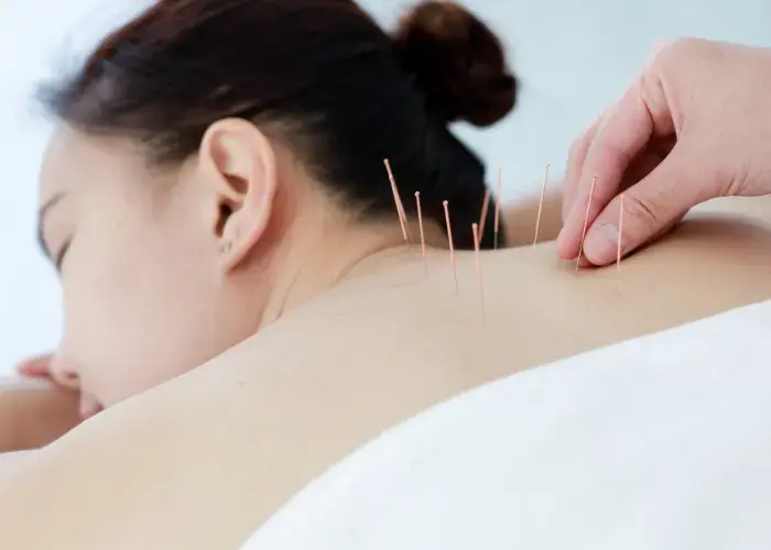 Needling Therapy in Mu mbai