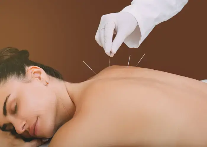 Dry Needling Therapy procedure