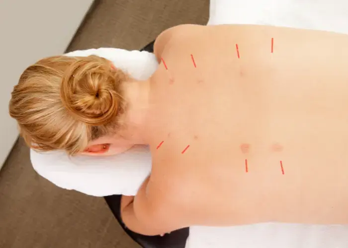 dry needling for upper back pain